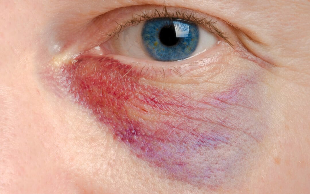How can you limit bruising with Botox and cosmetic fillers?